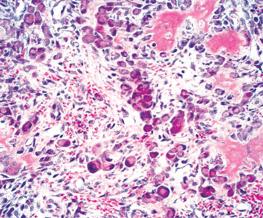 Pathology Outlines Osteoblastoma 8662